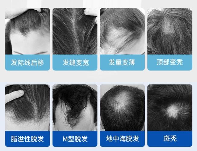 2025新澳门精准正版图库网站和因发量太多剃掉头发与因发量太多剃掉头发会怎么样